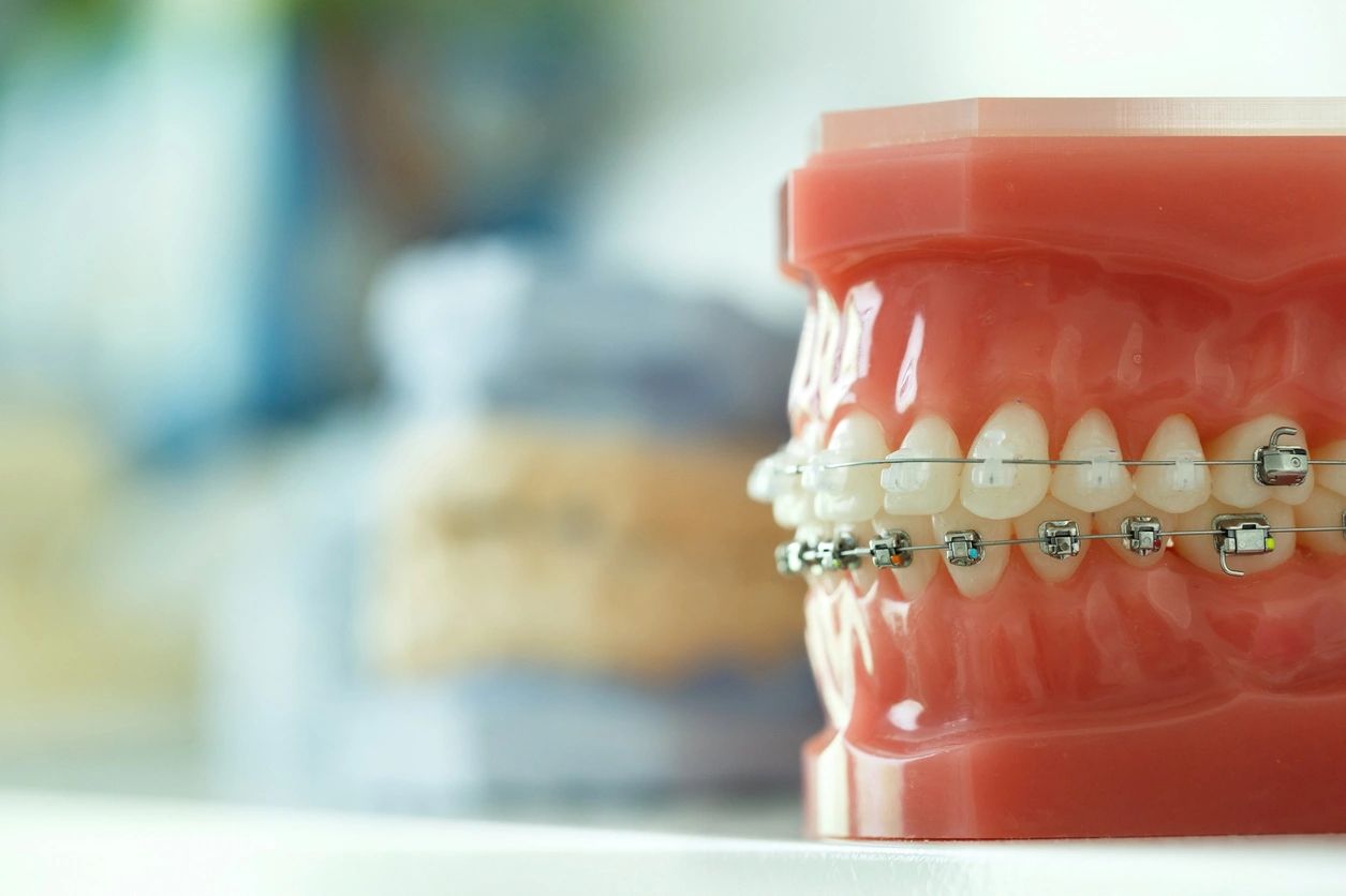 A close up of an artificial teeth with braces